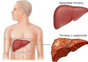 Ознаки цирозу печінки лікуватися чи печінку