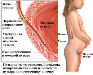 міхурово сечовідний рефлюкс