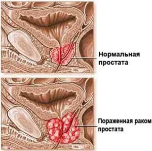 як лікувати рак простати 4 стадії