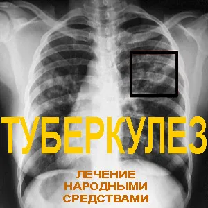 перші симптоми туберкульозу