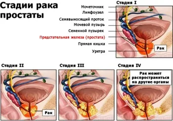 як лікувати рак простати 4 стадії