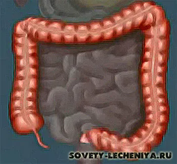 Рак кишечника, симптоми, ознаки та народні методи лікування як лікувати рак товстої кишки народними засобами