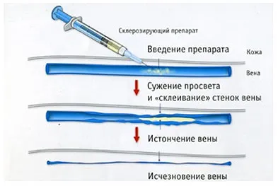 варикоз