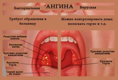 ніж лікувати алергію якщо болить горло