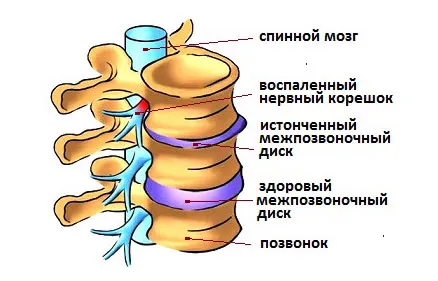 симптоми грудного радикуліту