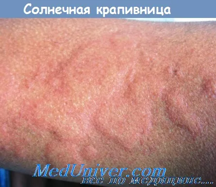 сонячна кропив'янка