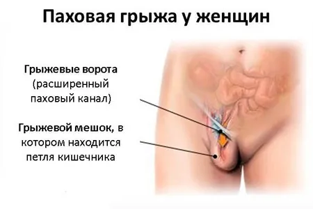 як лікувати розтягнення при вагітності