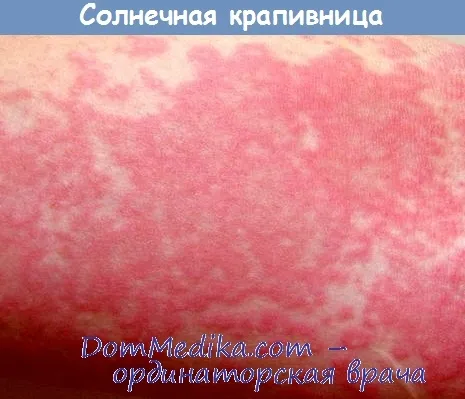 як лікувати сонячну кропив'янку