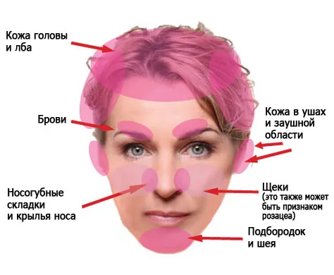 як лікувати дерматит на голові