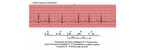Синусовааритмія у дітей і підлітків: виражена, помірна, дихательнаясінусовая... як лікувати аритмію у підлітків