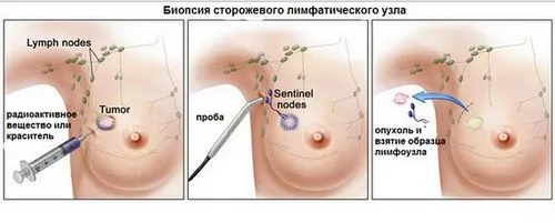 Рак молочної залози променева терапія раку молочної залози