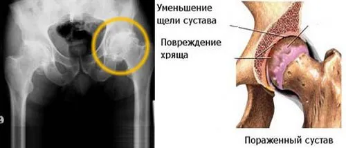 як лікувати остеохондроз тазостегнового суглоба