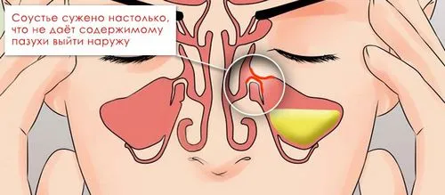 ніж лікувати синусит у дорослих