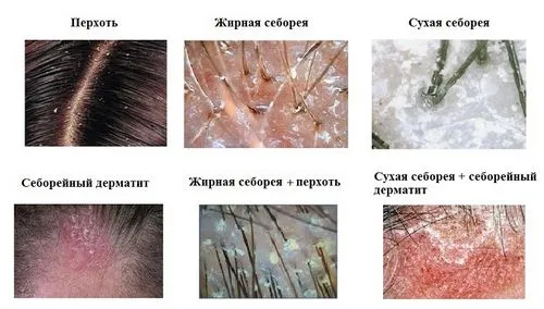 як лікувати себорейний дерматит на голові народними засобами