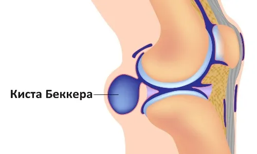 як лікувати інфекційний бурсит