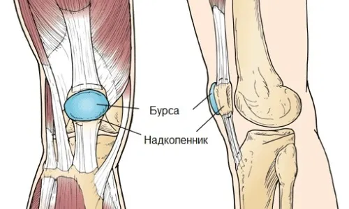 як лікувати інфекційний бурсит