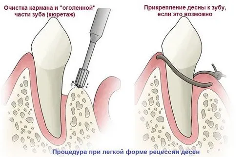 рецесія ясен