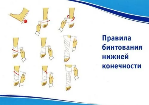 тромбофлебіт при вагітності лікування