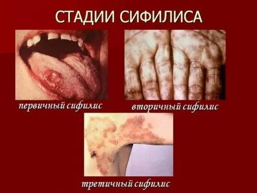 як лікують сифіліс в лікарні