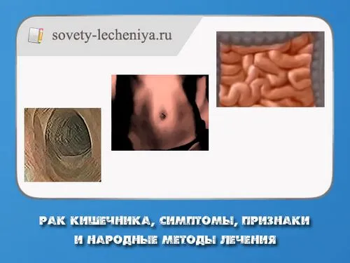 Рак кишечника, симптоми, ознаки та народні методи лікування як лікувати рак товстої кишки народними засобами
