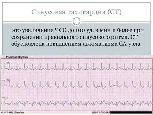 як лікувати тахікардію у дітей