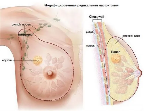 Рак молочної залози рак молочної залози лікування