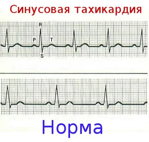 як лікувати тахікардію у дітей