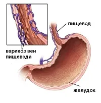 як вилікувати варикозне розширення вен стравоходу