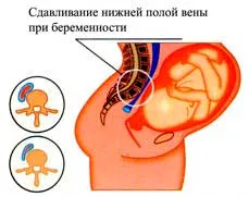 як лікувати варикоз малого таза під час вагітності