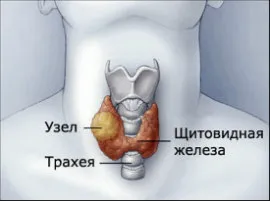 вилікувати вузловий зоб