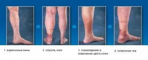 як лікувати варикоз на ранніх стадіях