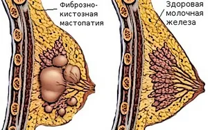 лікувати мастопатію травами