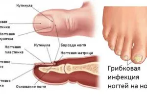 як лікувати товсті нігті на ногах