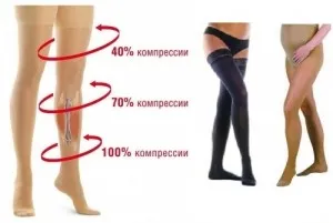 як лікувати варикоз на ранніх стадіях