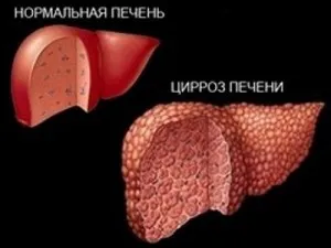 як вилікувати печінку назавжди