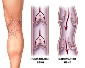 як лікувати варикоз ніг в домашніх умовах