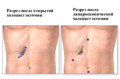 як лікувати печінку якщо видалений жовчний міхур