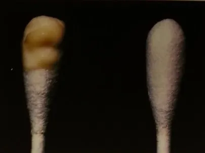 chlamydia trachomatis