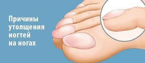 як лікувати товсті нігті на ногах