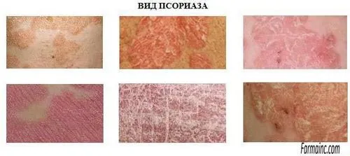 Типи (види) псоріазу лікування
