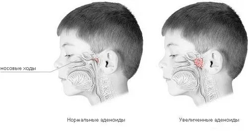 Збільшені аденоїди у дітей вилікувати аденоїди у дитини