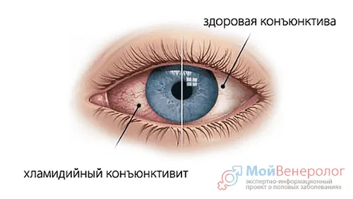 як лікують хламідіоз у дітей
