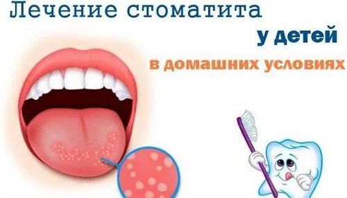 як вилікувати стоматит раз і назавжди