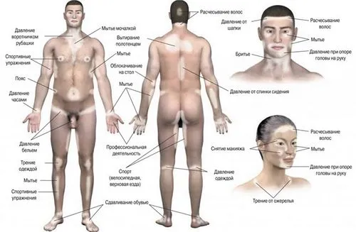 як лікувати вітіліго народними засобами