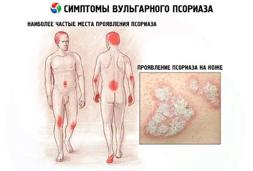 вульгарний псоріаз