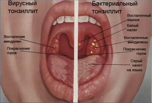 як лікувати вірусний тонзиліт