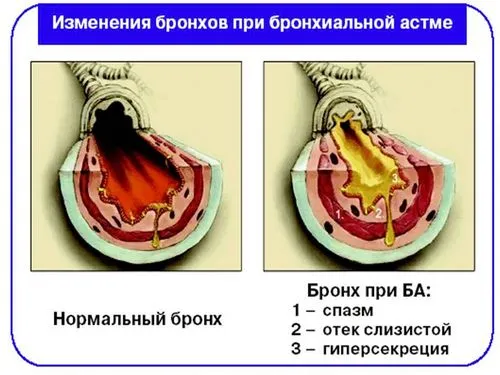як лікувати кашель при астмі