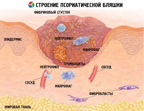 як лікувати вульгарний псоріаз