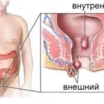 як вилікувати геморой і свербіж