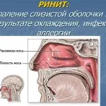 як лікувати атрофічний риніт